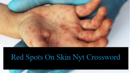 Red Spots On Skin Nyt Crossword Www jpunews